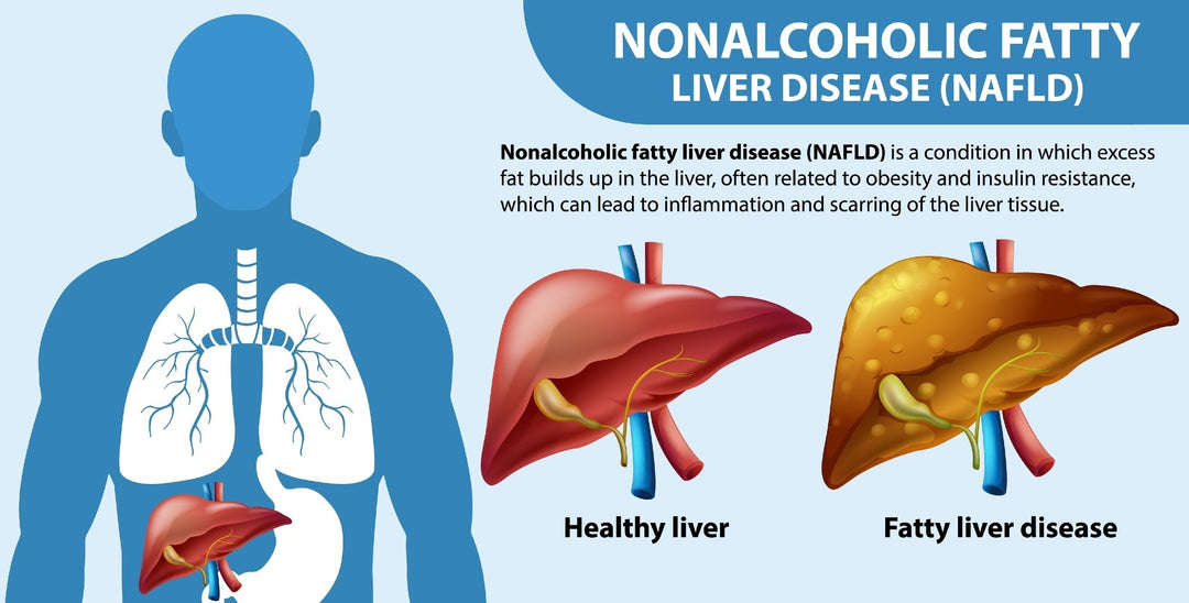 NON-ALCOHOLIC FATTY LIVER DISEASE (NAFLD) IN INDIA: UNDERSTANDING RISKS AND NATURAL REMEDIES