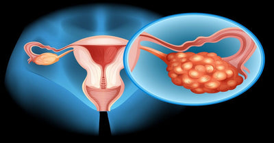 Fertility and PCOD